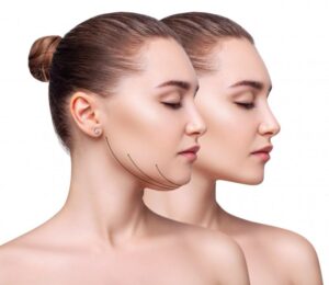 Kybella